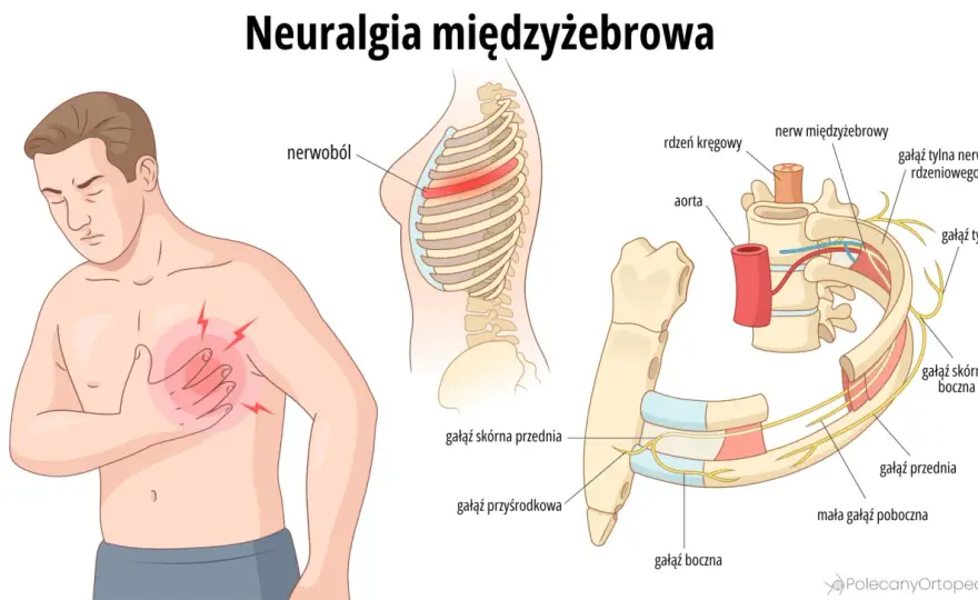 Neuralgia międzyżebrowa - jak rozpoznać ból i odróżnić od serca