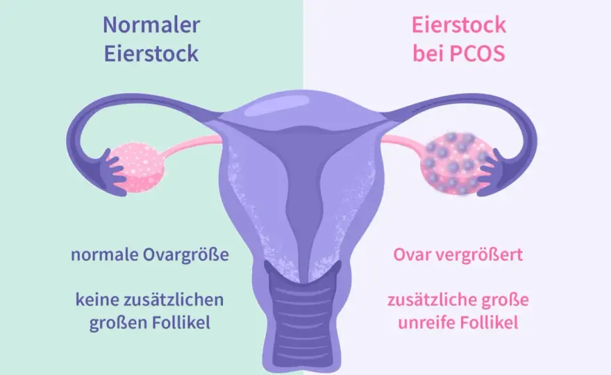 Objawy PCOS - jak je rozpoznać i co oznaczają dla ciąży?
