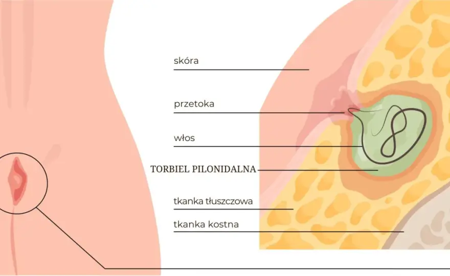 Torbiel włosowa - objawy, które łatwo przeoczyć i kiedy działać
