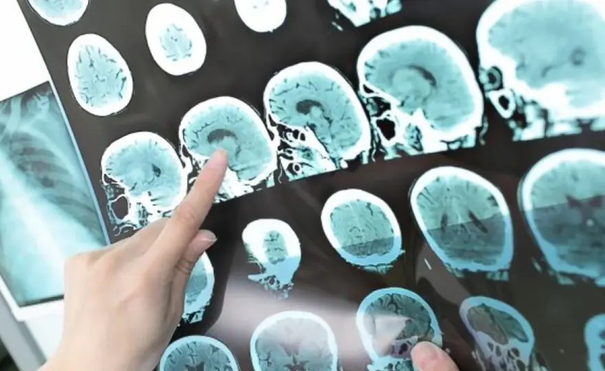Stwardnienie rozsiane - Domowy test? Kiedy do neurologa?