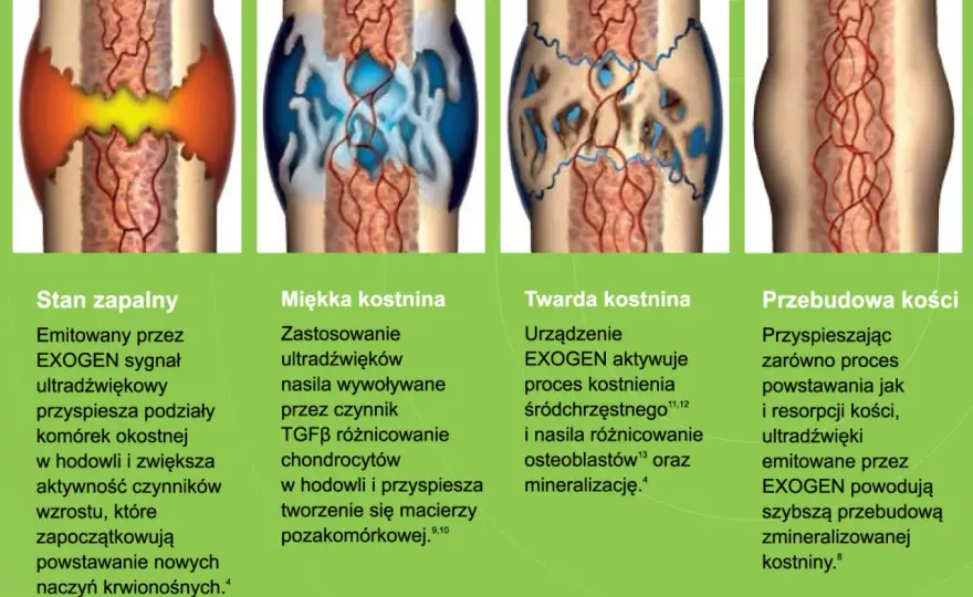 Łamliwość kości - kiedy mały uraz kończy się złamaniem?
