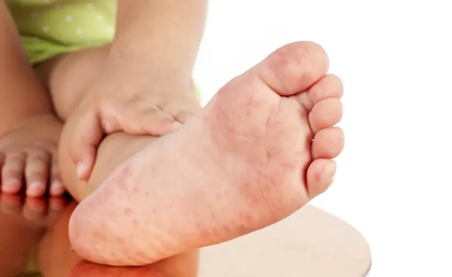 Fucibet Lipid na stopach - kiedy ma sens?