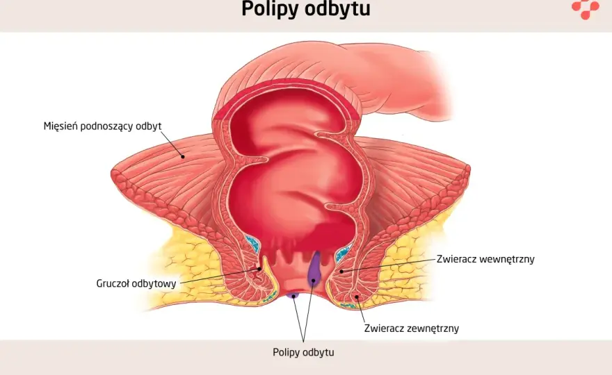 Polipy - Jak czytać wyniki i kiedy są groźne?