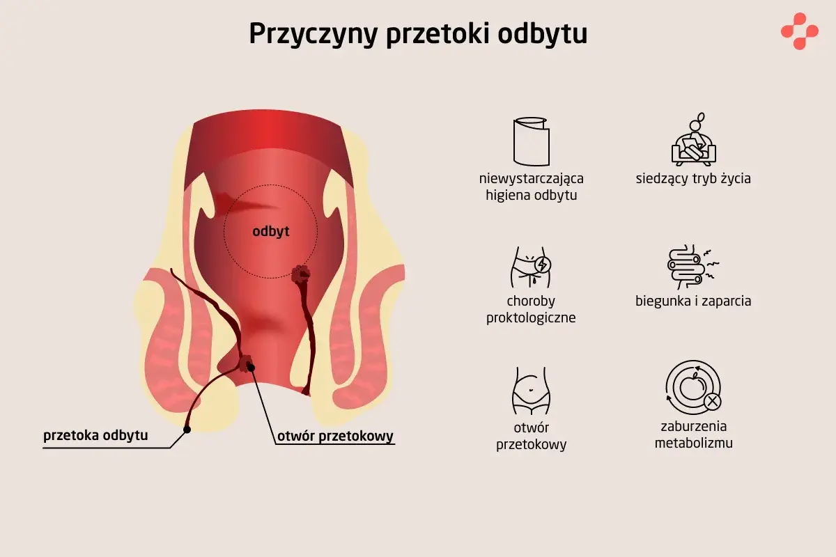 Ilustracja przedstawia anatomię odbytu z widoczną przetoką odbytu, wskazując na jej przyczyny, takie jak choroby proktologiczne czy zaburzenia metabolizmu.