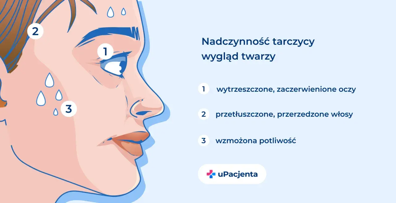 Nadczynność tarczycy objawy: wytrzeszczone oczy (1), przetłuszczone włosy (2) i wzmożona potliwość (3) na twarzy.