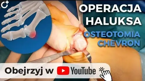 Czy haluksy odrastają? Odkryj prawdę o nawrotach po operacji
