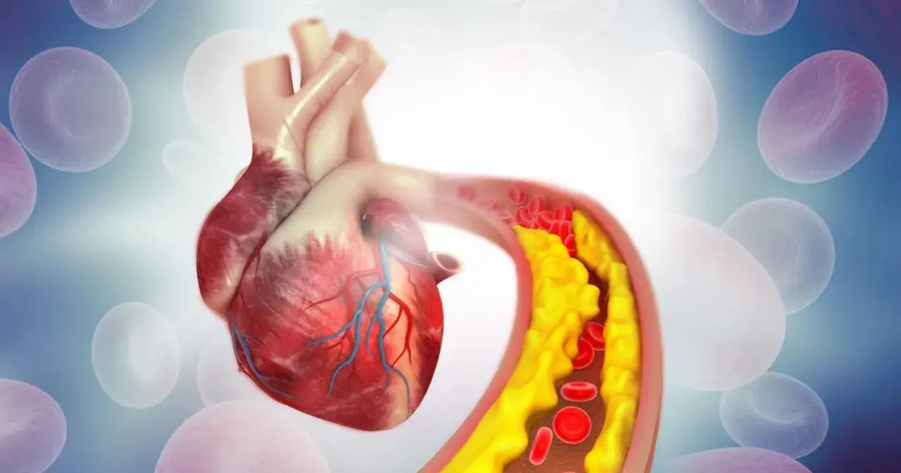Serce i tętnica z cholesterolem. Wysoki cholesterol nie HDL może prowadzić do zwężenia naczyń.