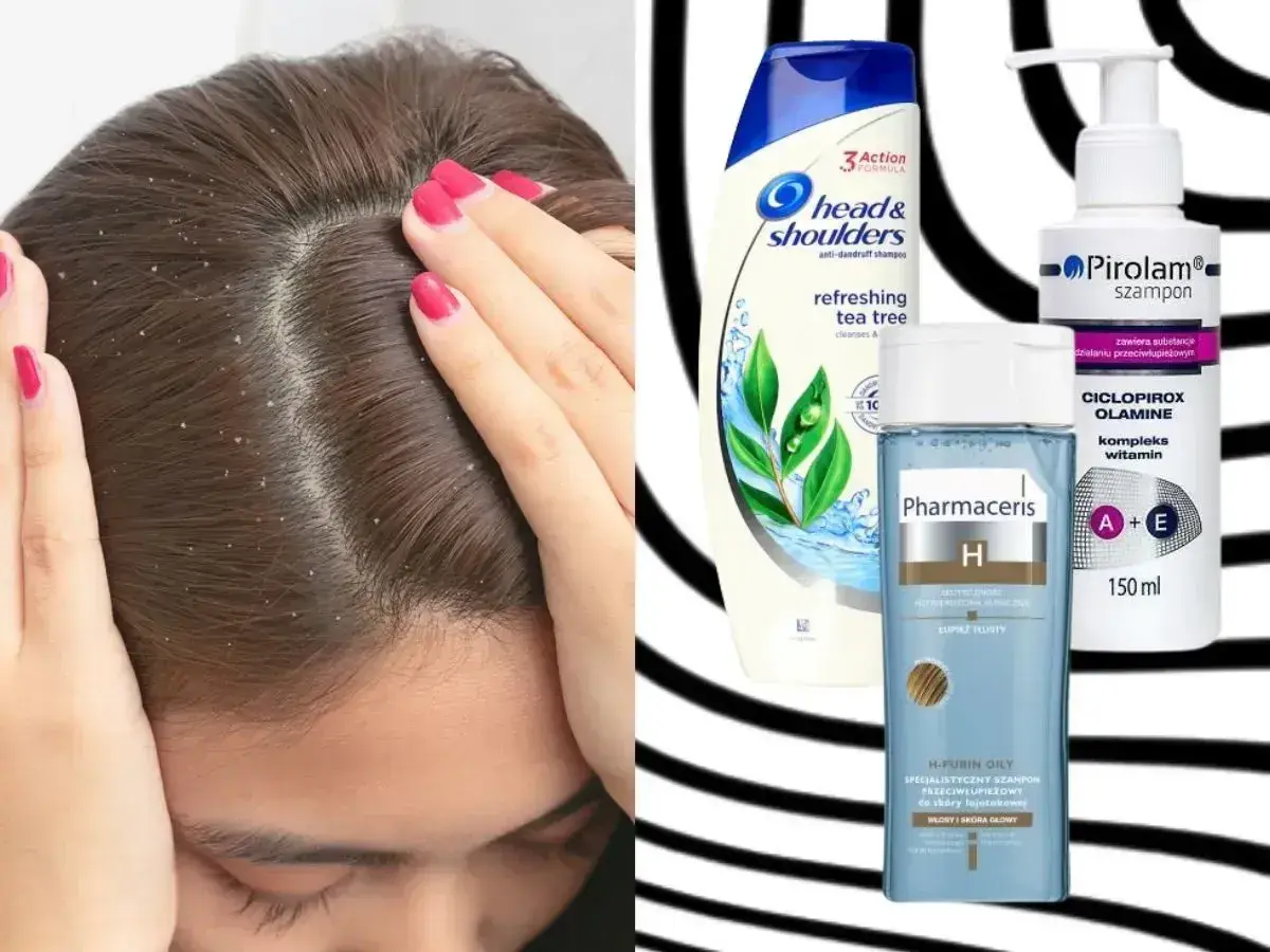 Kobieta z łupieżem na głowie. Obok szampony Head & Shoulders, Pirolam i Pharmaceris – co na łupież.
