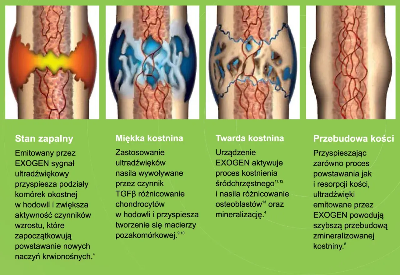Ilustracje pokazują etapy gojenia kości: stan zapalny, miękką i twardą kostninę, a na końcu przebudowę kości. Proces ten, dzięki EXOGEN, przyspiesza tworzenie nowej tkanki kostnej, redukując problem **łamliwości kości**.