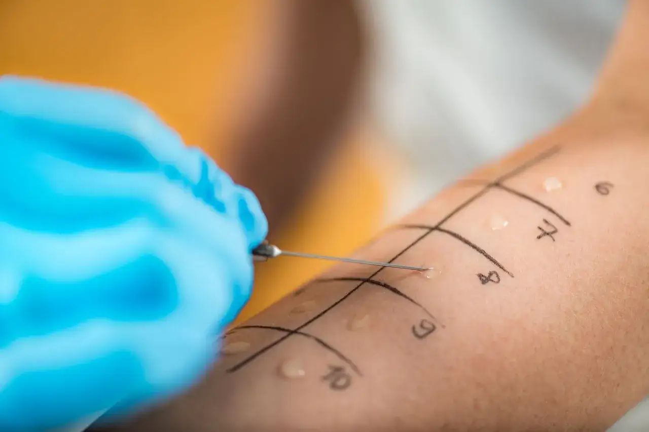 Ręka z zaznaczonymi polami do testów alergicznych. Igła wprowadza substancję pod skórę, rozpoczynając diagnostykę.