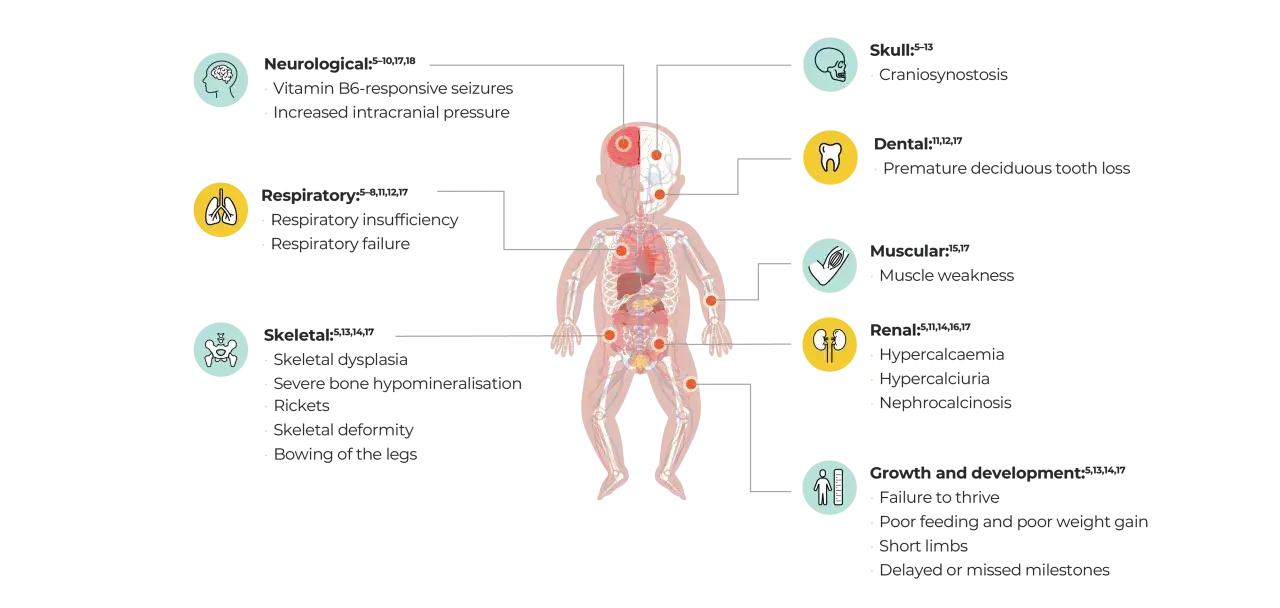 Schemat przedstawia objawy hipoplazji: neurologiczne, oddechowe, kostne, czaszki, zębów, mięśniowe, nerek oraz problemy ze wzrostem i rozwojem.