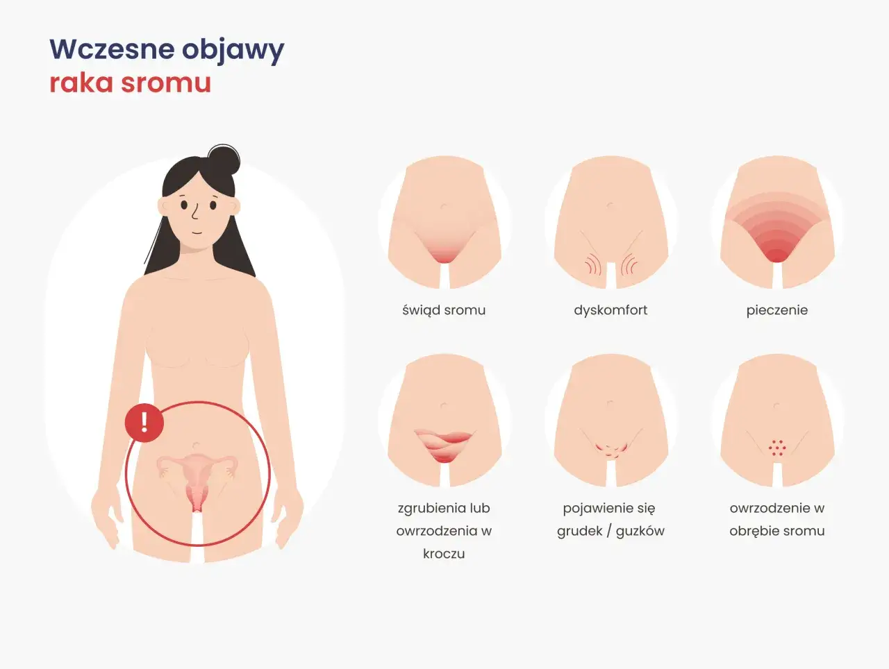 Ilustracja przedstawia wczesne objawy raka sromu: świąd, dyskomfort, pieczenie, zgrubienia, grudki i owrzodzenia.