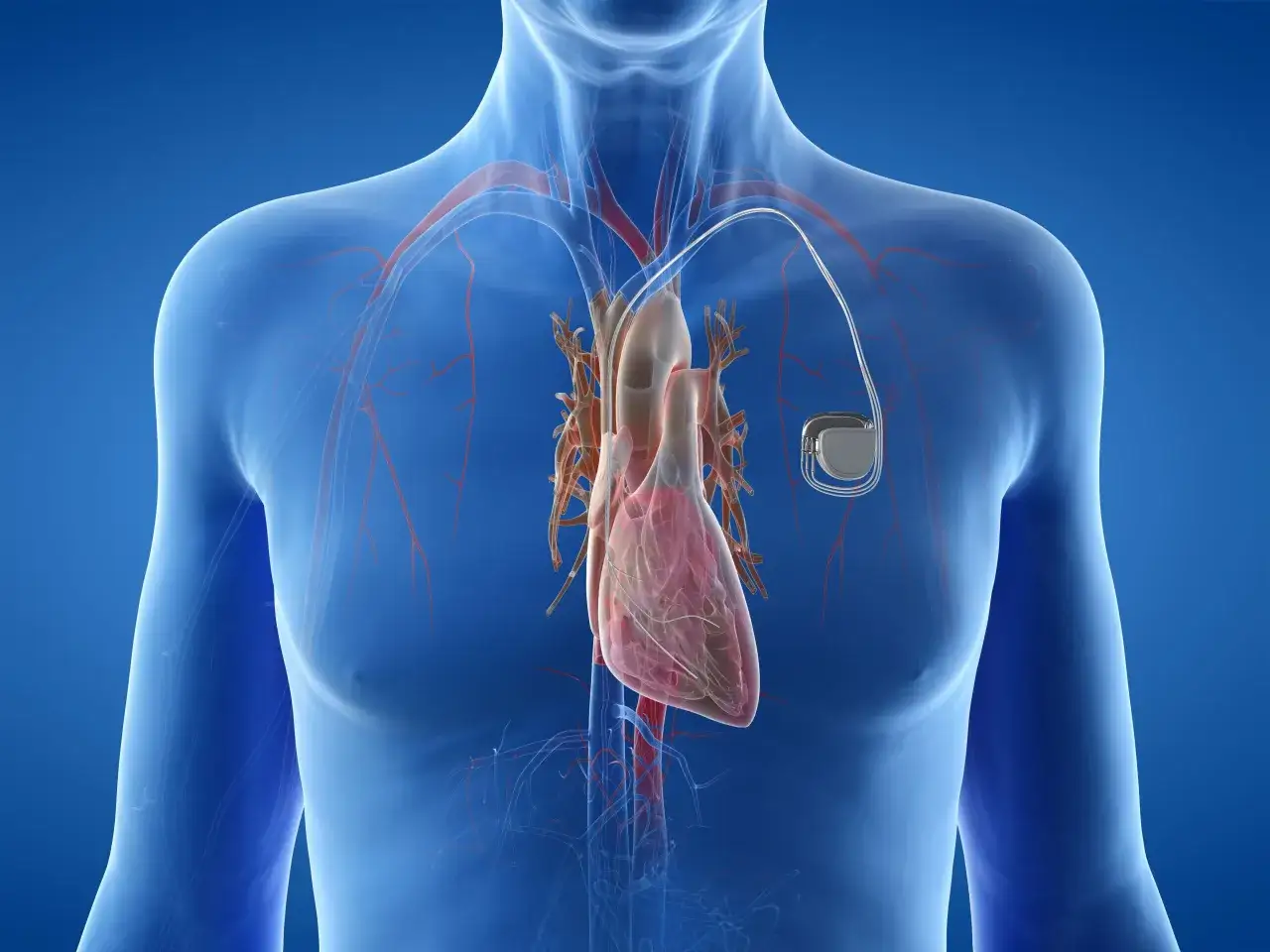Anatomical illustration of a human chest showing the heart and blood vessels, with a rozrusznik serca implanted near the collarbone.