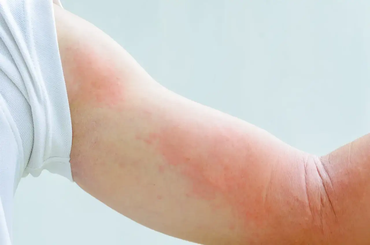Ramię z zaczerwienieniem i wysypką, sugerujące reakcję alergiczną. Wyniki testów alergicznych z krwi mogą pomóc zidentyfikować przyczynę.