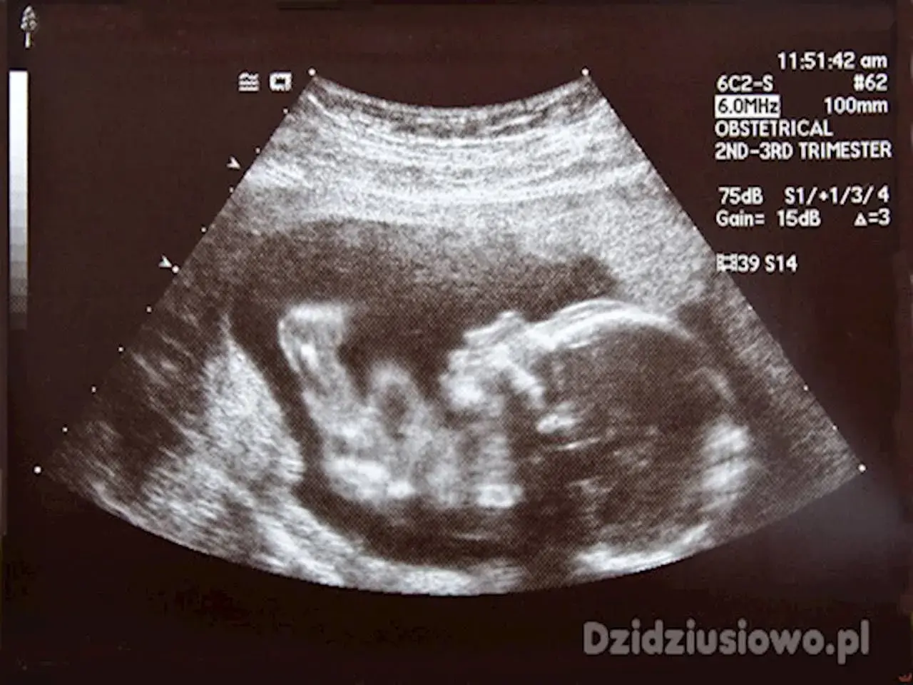 Obraz z badania prenatalnego pokazuje profil dziecka w 2. lub 3. trymestrze ciąży.