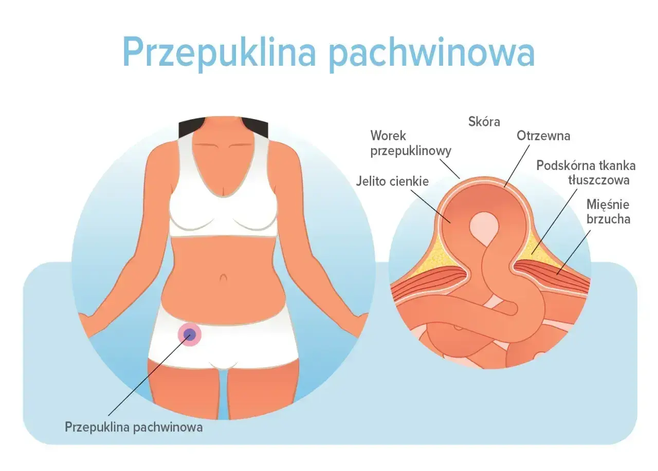 Ilustracja pokazuje przepuklinę pachwinową u kobiety. Widoczny jest przekrój anatomiczny, uwidaczniający jelito cienkie w worku przepuklinowym, co jest jednym z objawów przepukliny.