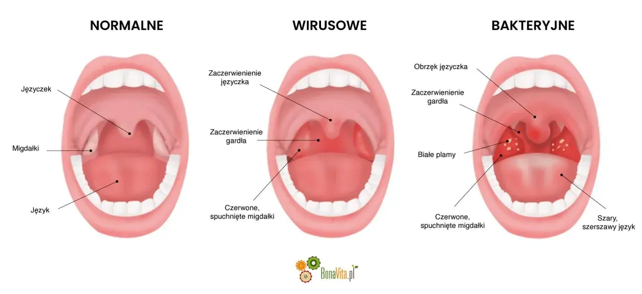 Porównanie gardła dziecka: normalne, wirusowe i bakteryjne. W przypadku anginy bakteryjnej widoczne są białe plamy na migdałkach.