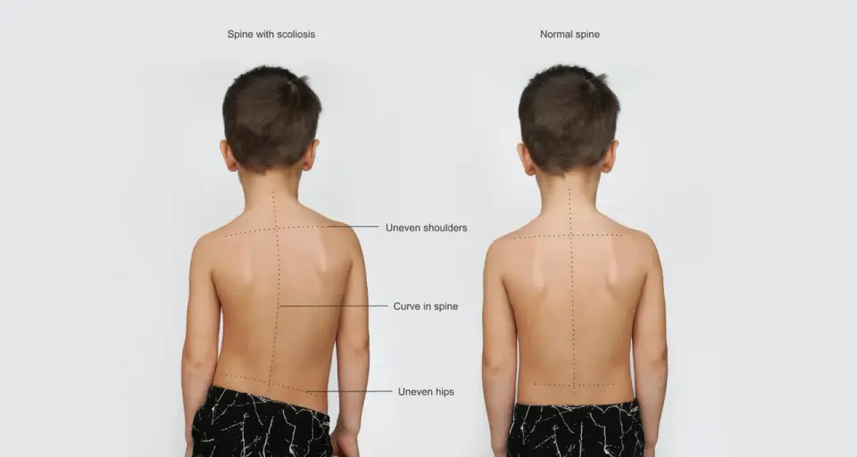 Skolioza czy wada postawy? Objawy, diagnostyka i leczenie